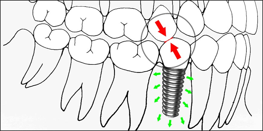 Occlusion in implant dentistry. A review of the literature of prosthetic  determinants and current concepts, Gross 2008